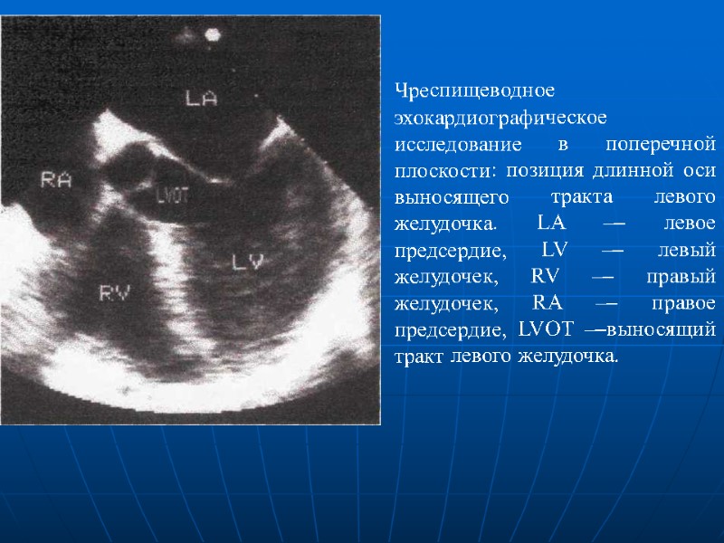 Чреспищеводное эхокардиографическое исследование в поперечной плоскости: позиция длинной оси выносящего тракта левого желудочка. LA Чреспищеводное эхокардиографическое исследование в поперечной плоскости: позиция длинной оси выносящего тракта левого желудочка. LA